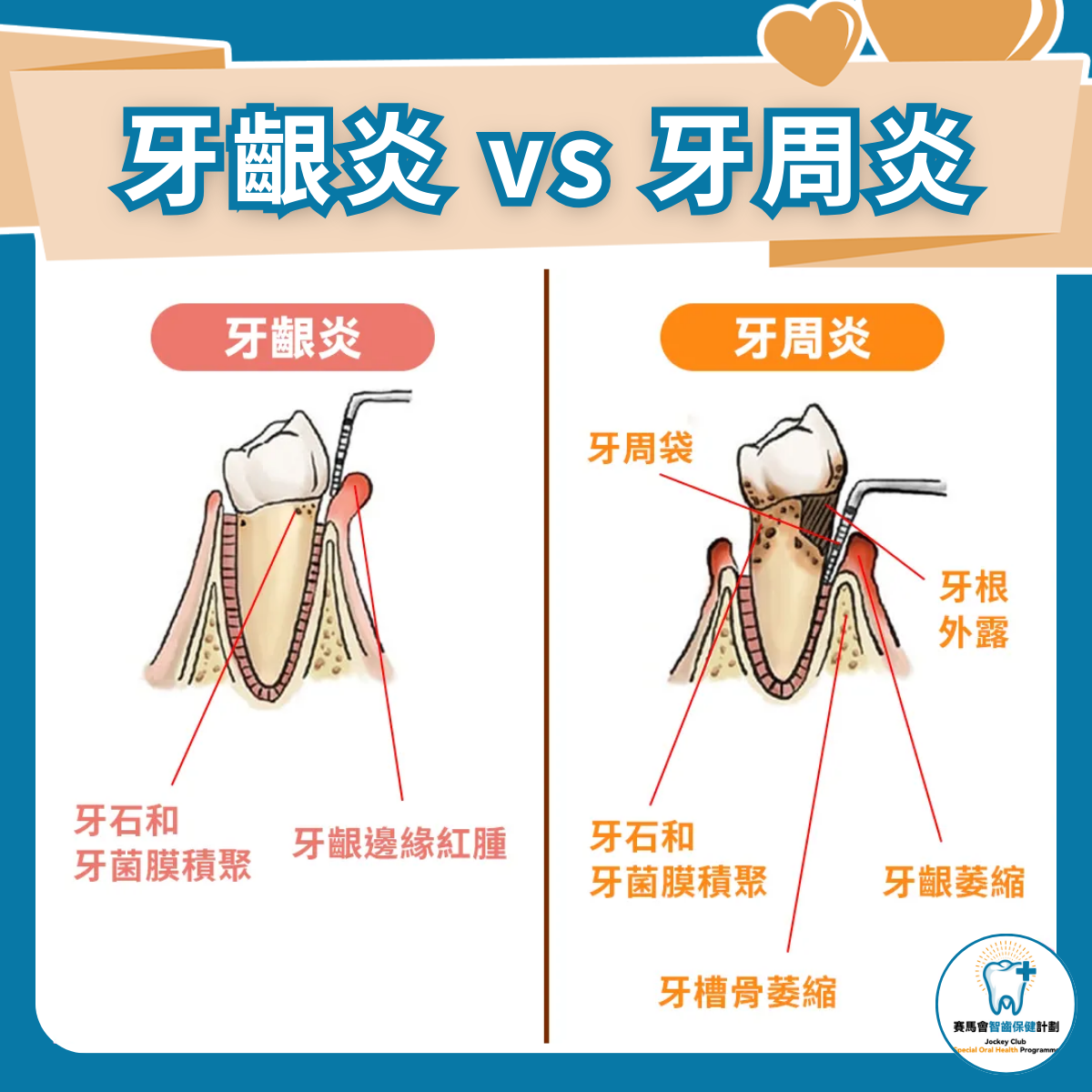 牙周病是什麼？患上牙周病怎麼辦，認識牙周病的3大治療方法 – 賽馬會智齒保健計劃